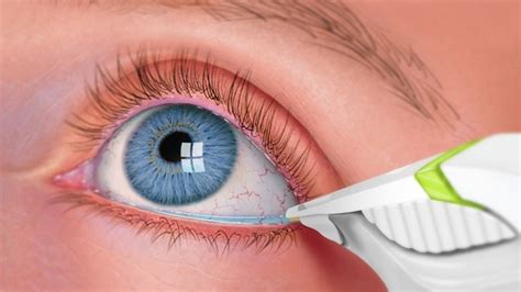 tear testing eyes|how to test for dry eyes.